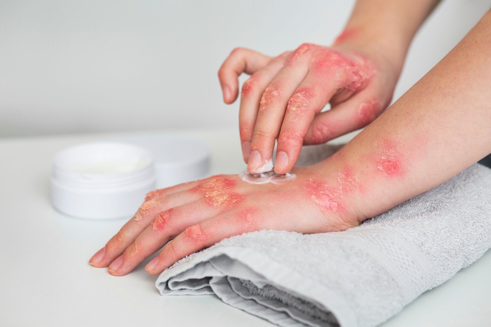 Burn Contracture Surgery